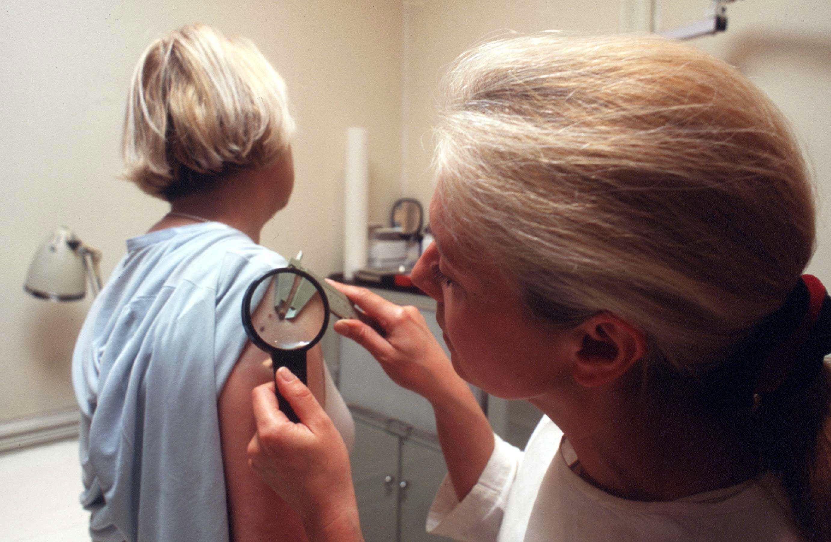 L’eczéma pourrait réduire le risque de cancer de la peau