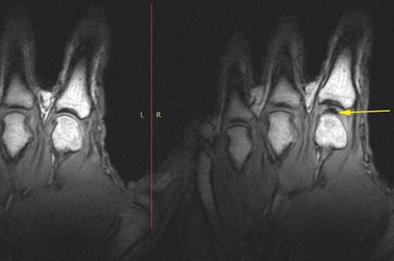 Le mystère des craquements de doigts résolus grâce à l'IRM