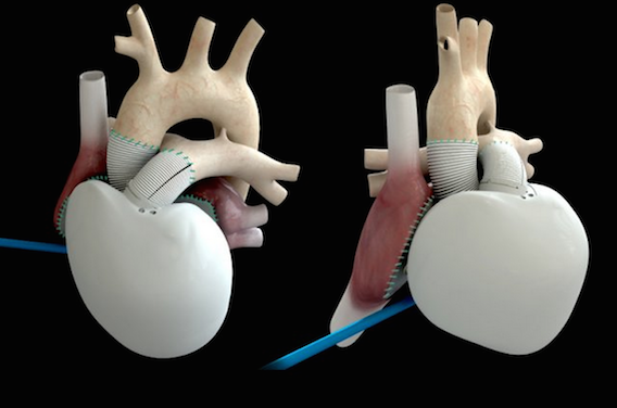 Coeur Carmat : 1ères révélations cliniques sur les patients implantés