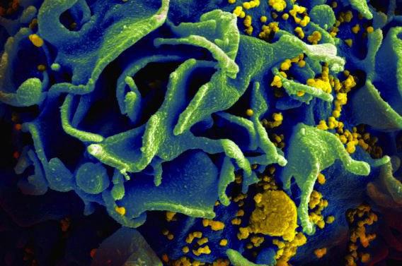 VIH : des anticorps capables de neutraliser les cellules infectées