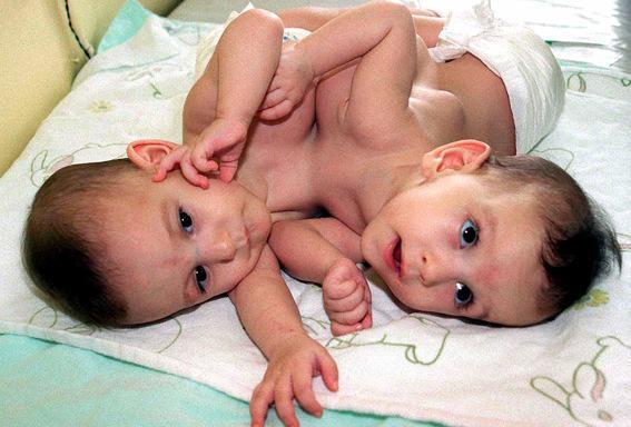 Suisse : des sœurs siamoises opérées à l’âge de 8 jours