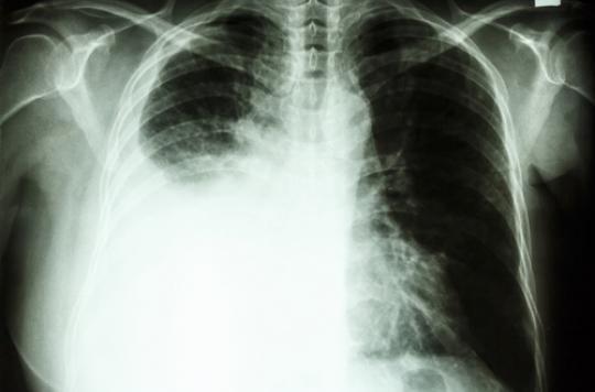 Cancer Du Poumon Depistage