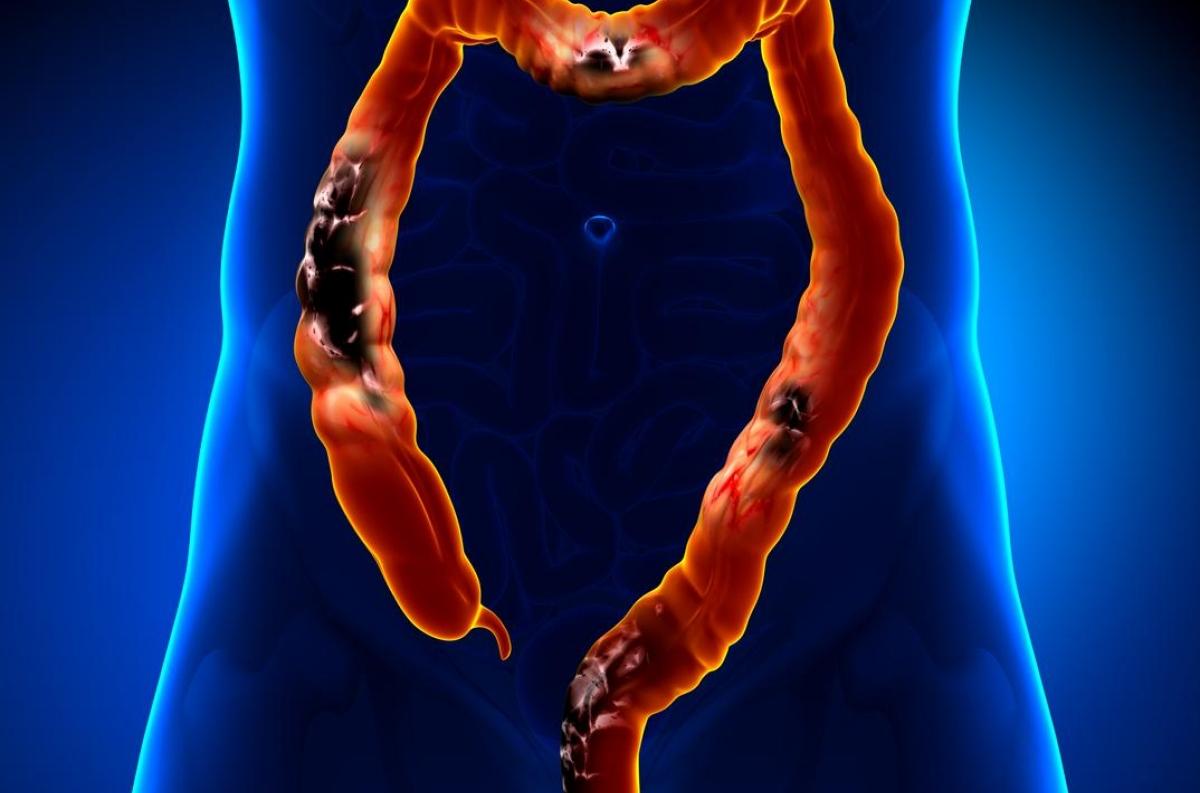 Cancerul de colon: cauze, simptome, tratament
