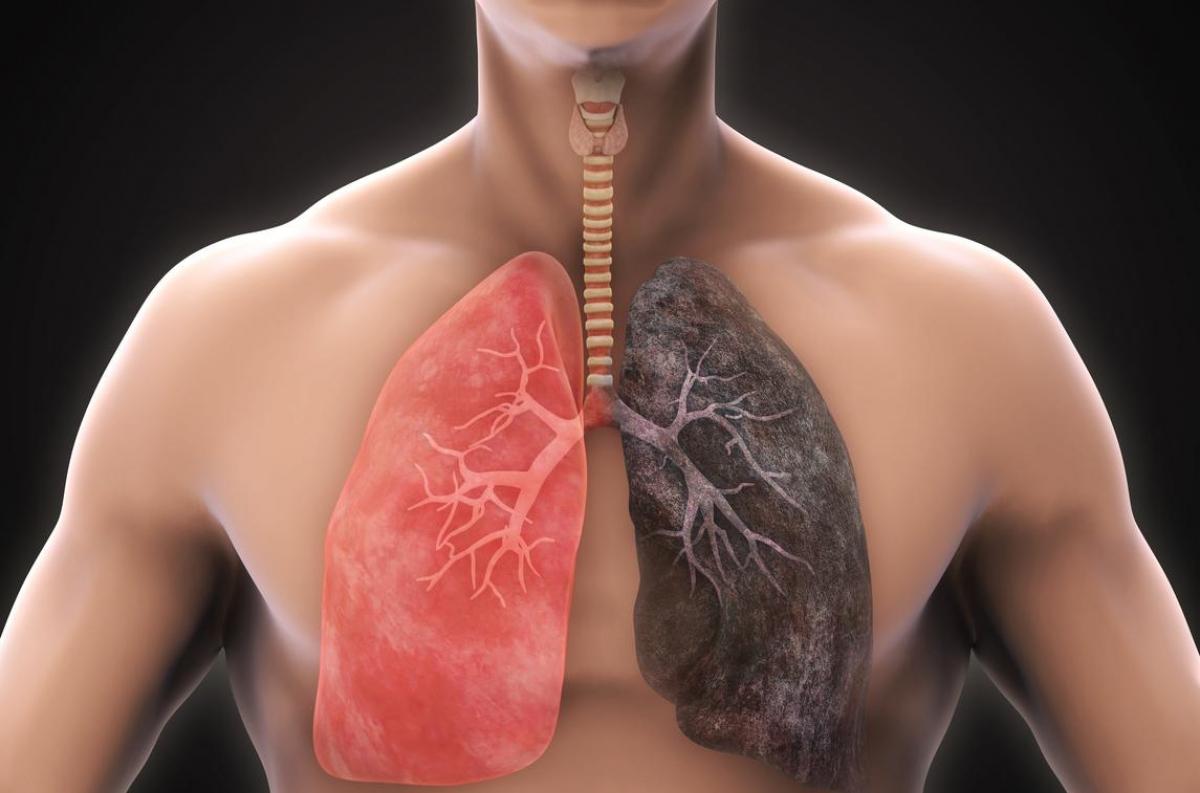 Cancer du poumon : les progrès du traitement sont constants ...