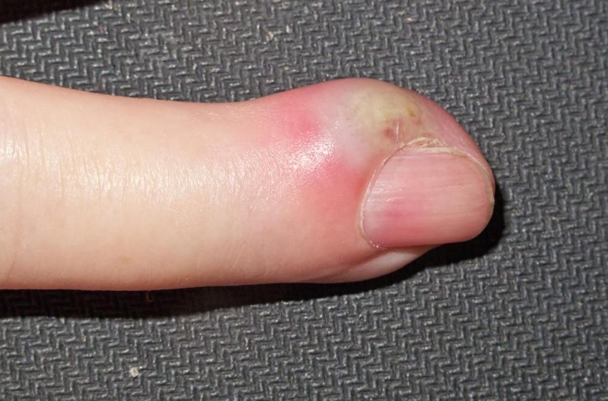 Panaris : une infection du doigt à désinfecter sans tarder ...