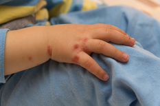 Problèmes de peau chez les enfants : l'éruption cutanée aide le ...