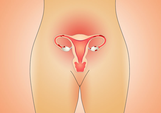 Troubles hormonaux : des Règles douloureuses à l'Endométriose