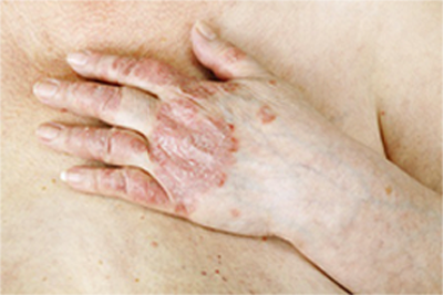 complications psoriasis rhumatisme vörös foltok pikkelyesedéssel az egész testen