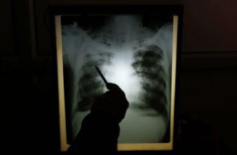 Tuberculose : la situation s'améliore, sauf en Seine-Saint-Denis