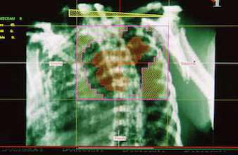 Cancer du poumon : 30 % de décès trois mois après le diagnostic