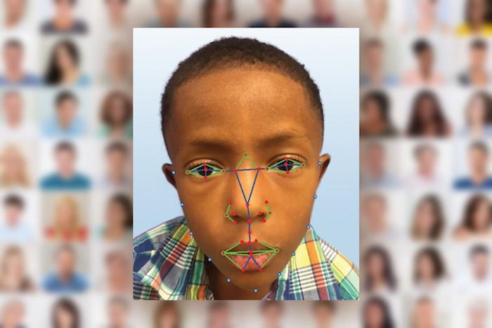 Maladies rares : la reconnaissance faciale pour réduire l'errance diagnostique