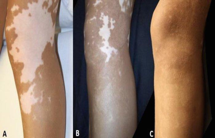 Vitiligo : l'autogreffe de peau est efficace à long terme