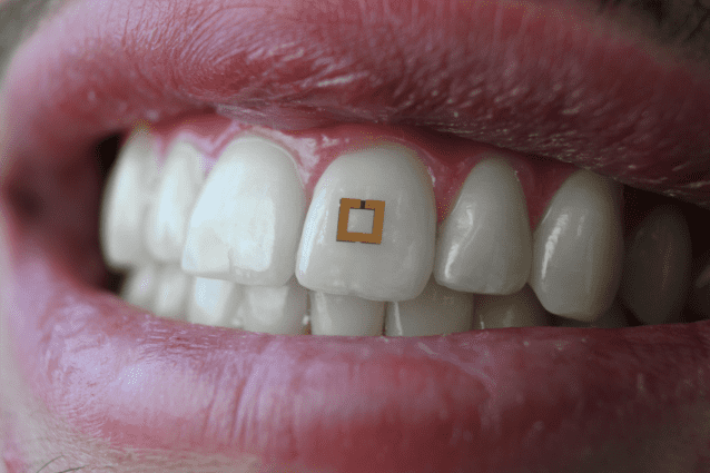 Des capteurs sur les dents pour mieux surveiller son alimentation