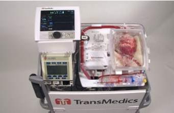Un cœur transplanté après l'arrêt cardiaque du donneur