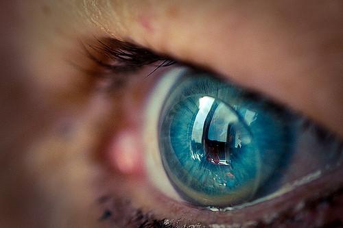 Cataracte : 27 lentilles retrouvées dans l'oeil d'une Anglaise