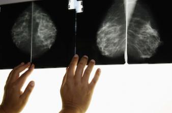 Mammographie : un résultat faux-positif ne détourne pas du dépistage  