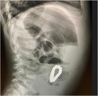 Un petit garçon opéré après avoir avalé 18 billes magnétiques