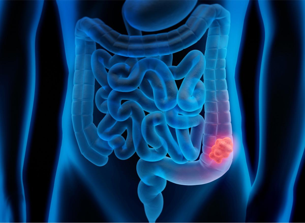 Cancer du colon : l’hérédité ne concerne pas que les proches au premier degré  