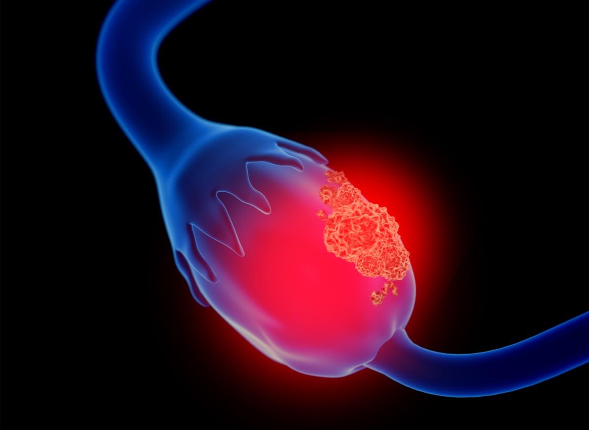 Cancer des ovaires : un traitement permet de préserver la fertilité