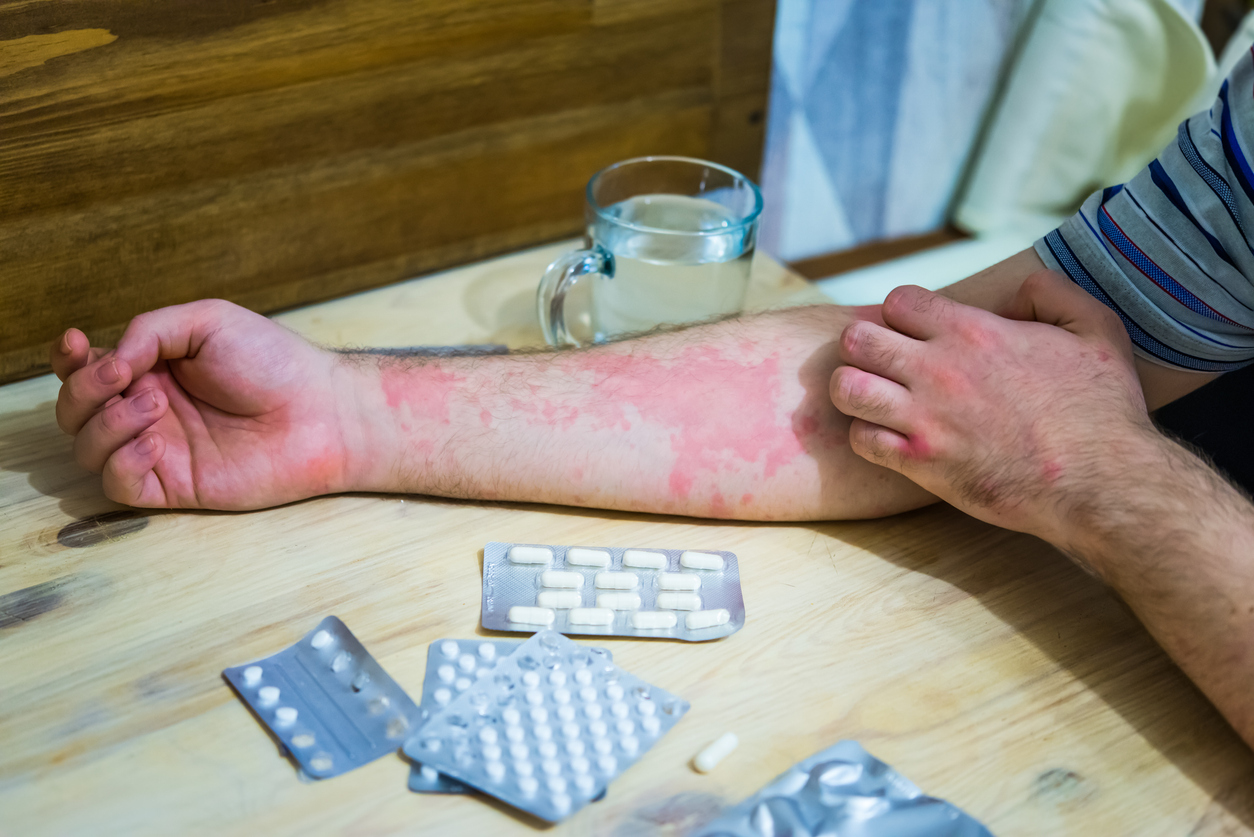 Alexandre, atteint d'eczéma sévère : \