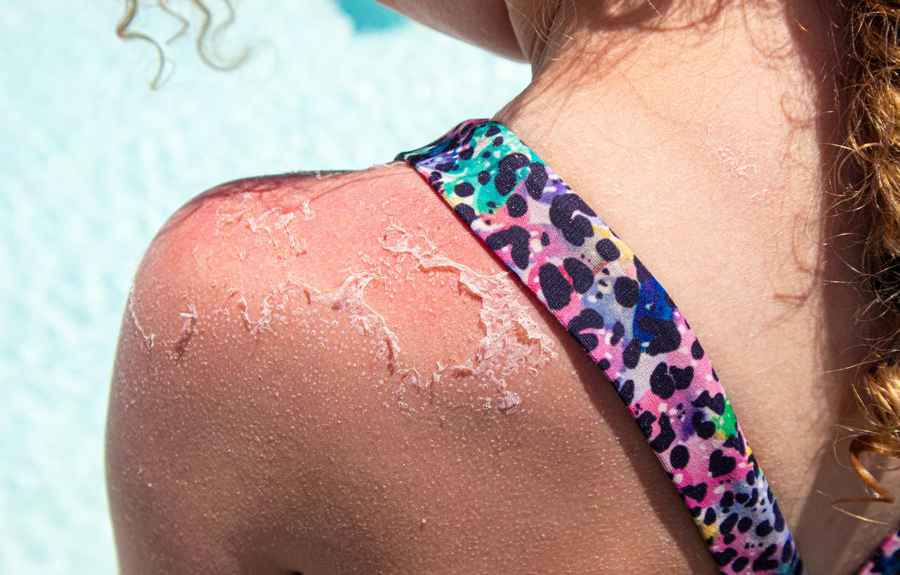 Coup de soleil : quand faut-il le traiter comme une brulûre ?