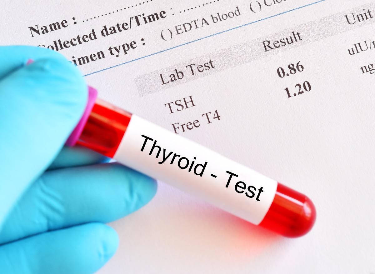 Cancer de la thyroïde : un nouveau test permettrait d’éviter les chirurgies inutiles 