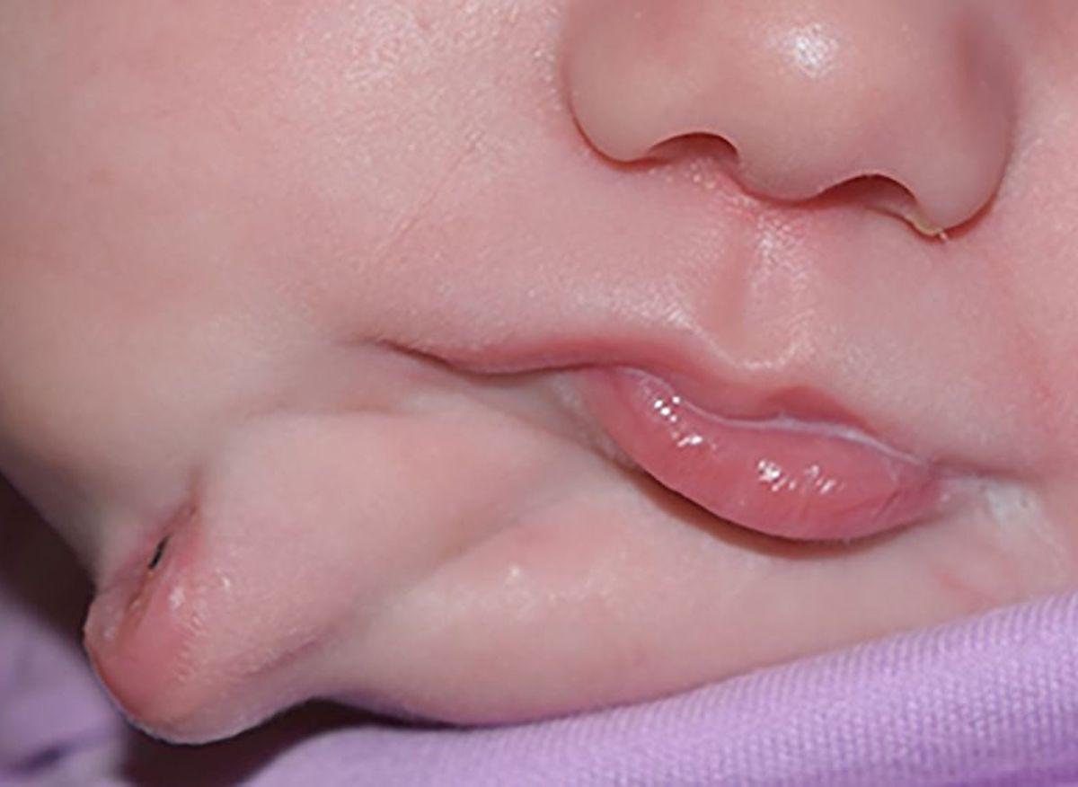 Diprosopie : un bébé naît avec deux bouches et deux langues