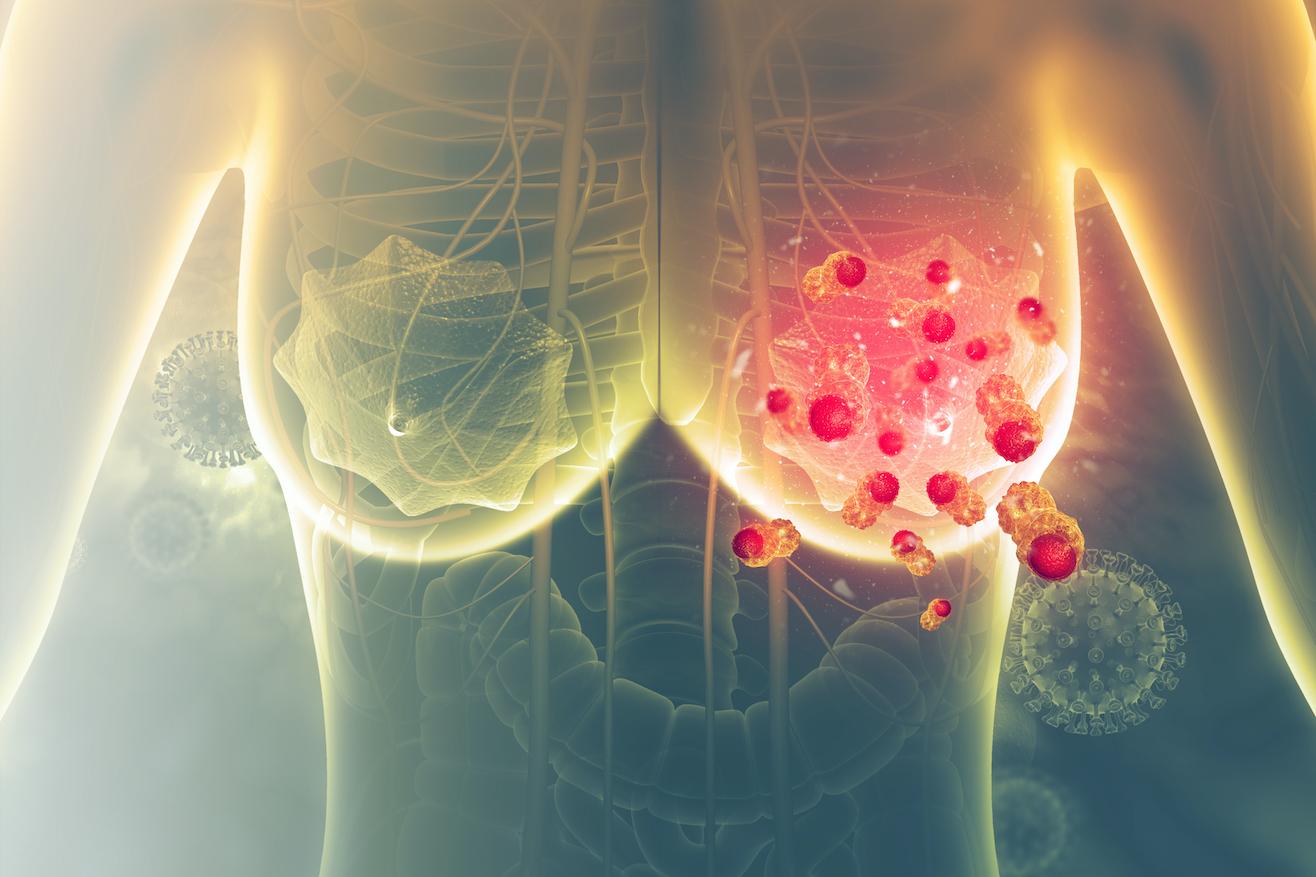Les cellules cancéreuses du sein se développent grâce aux particules de graisse alimentaire présentes dans le sang