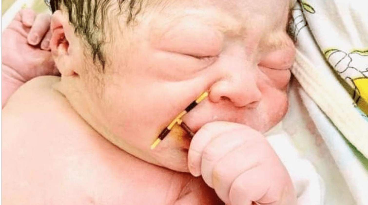 Au Vietnam, un bébé naît avec un stérilet à la main, la photo fait le tour du monde 