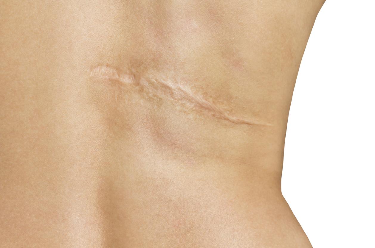 Comment éviter qu'une cicatrice ne devienne “hypertrophique”?