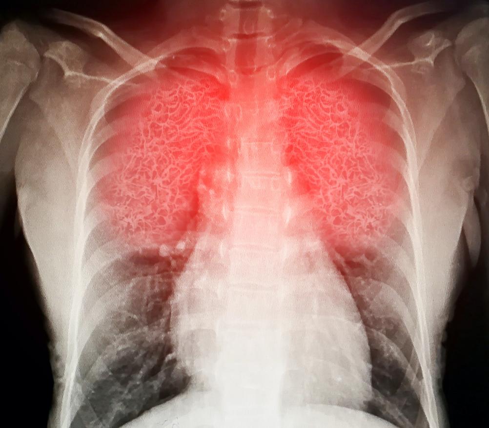 Covid-19: d’où viennent les lésions pulmonaires dont souffrent certains malades?