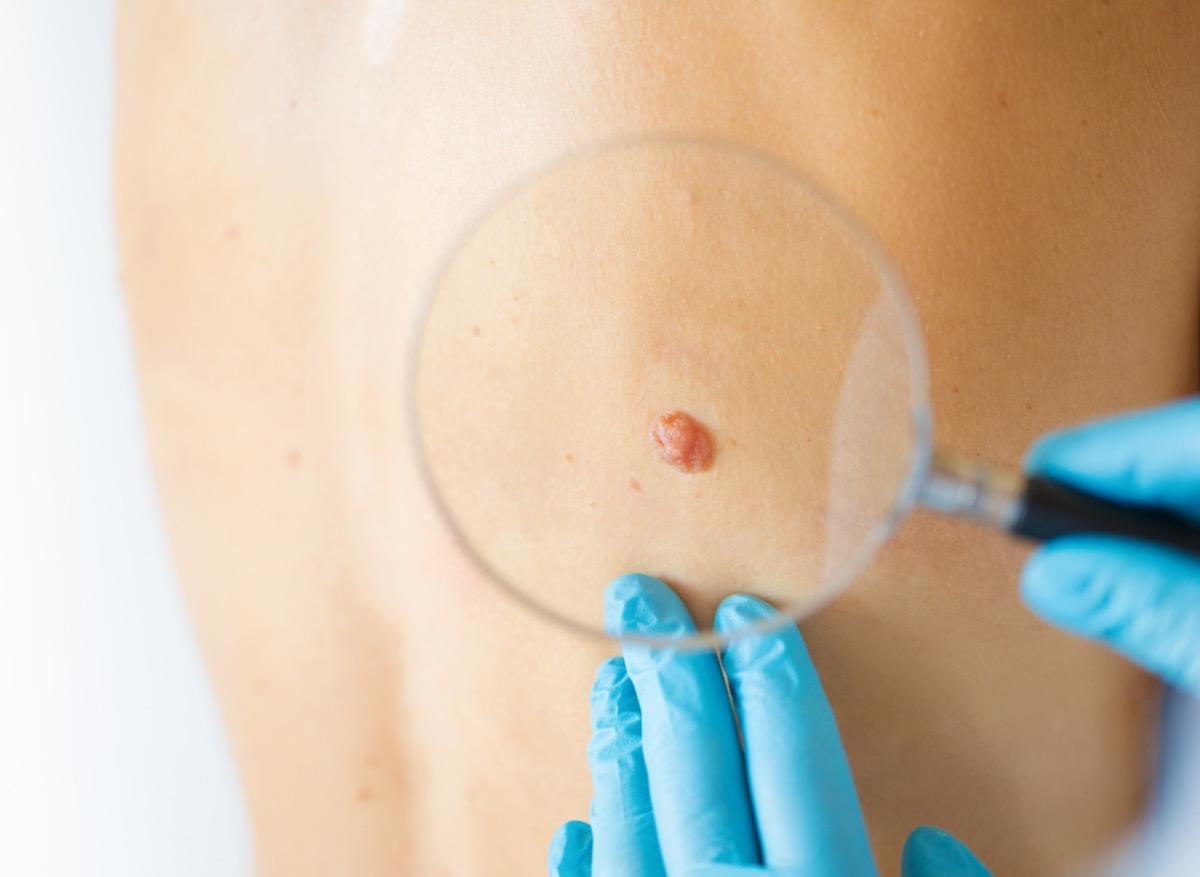 Mélanome : un marqueur sanguin permet d’optimiser le traitement 