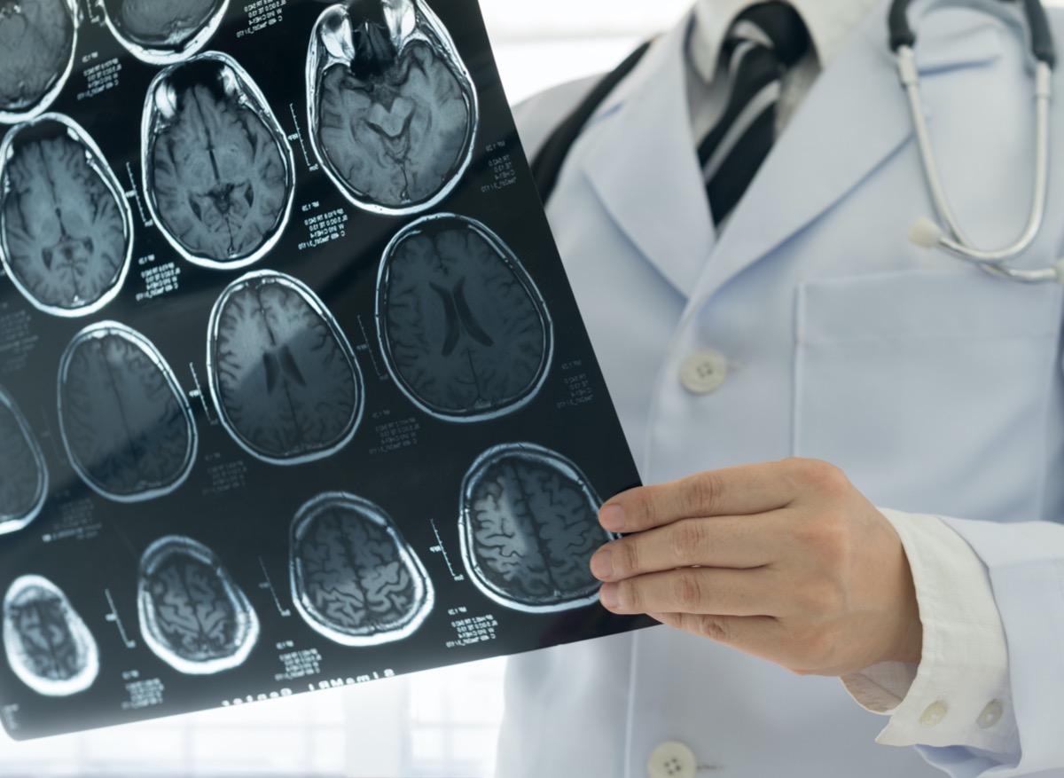 Pourquoi la Covid-19 augmente le risque d’accident vasculaire cérébral ? 