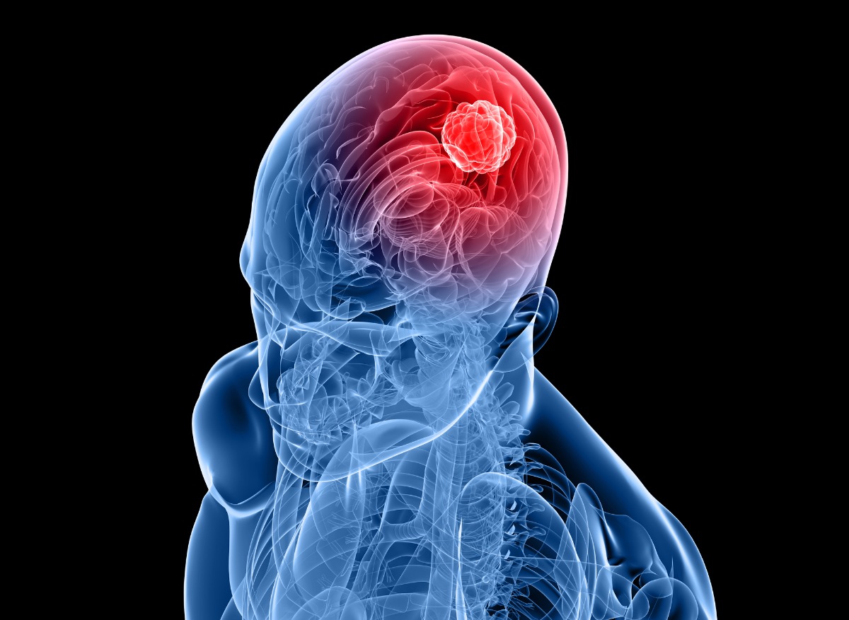 Cancer : le cerveau jouerait un rôle important dans le développement des tumeurs