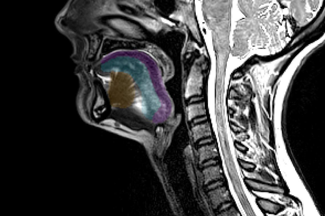 Une IRM de la langue pourrait aider à détecter la maladie de Charcot 