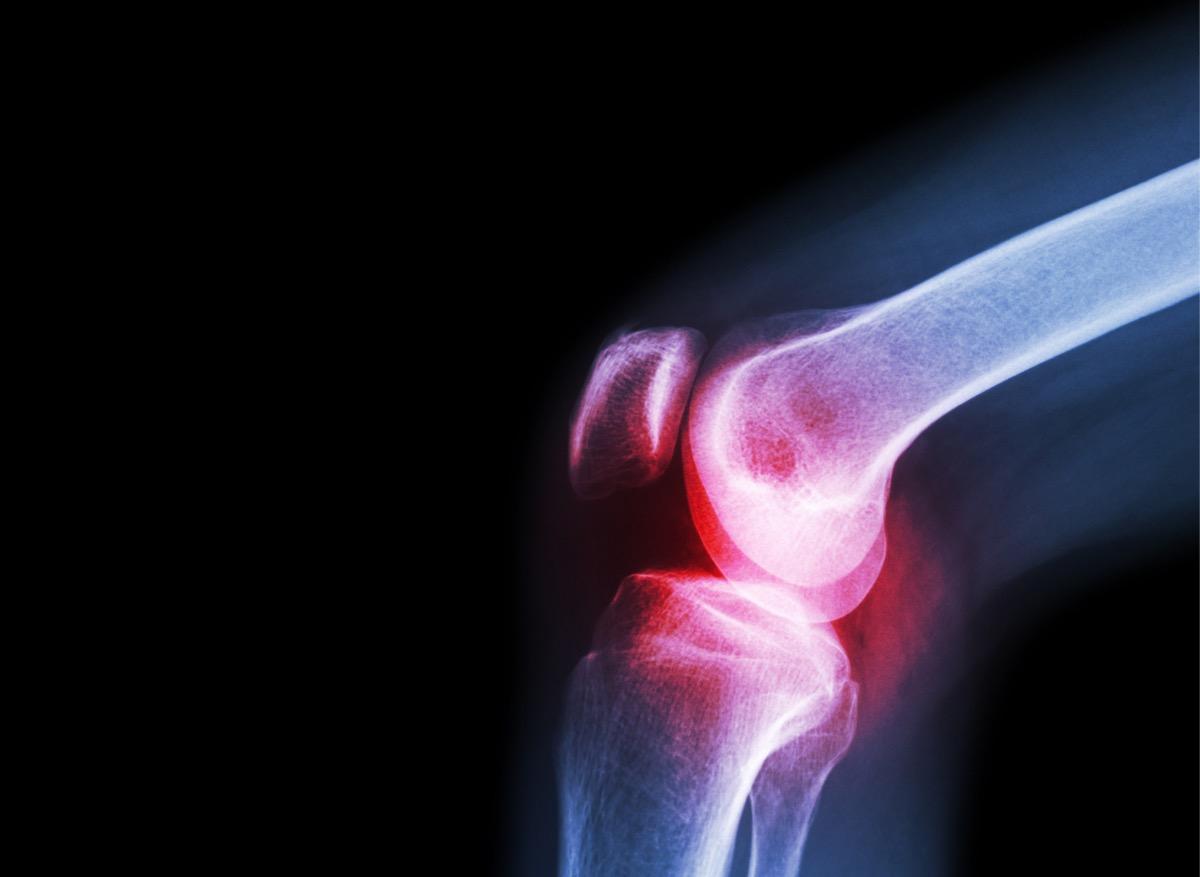 Arthrose du genou : l’hydrogel fait ses preuves pour remplacer le cartilage