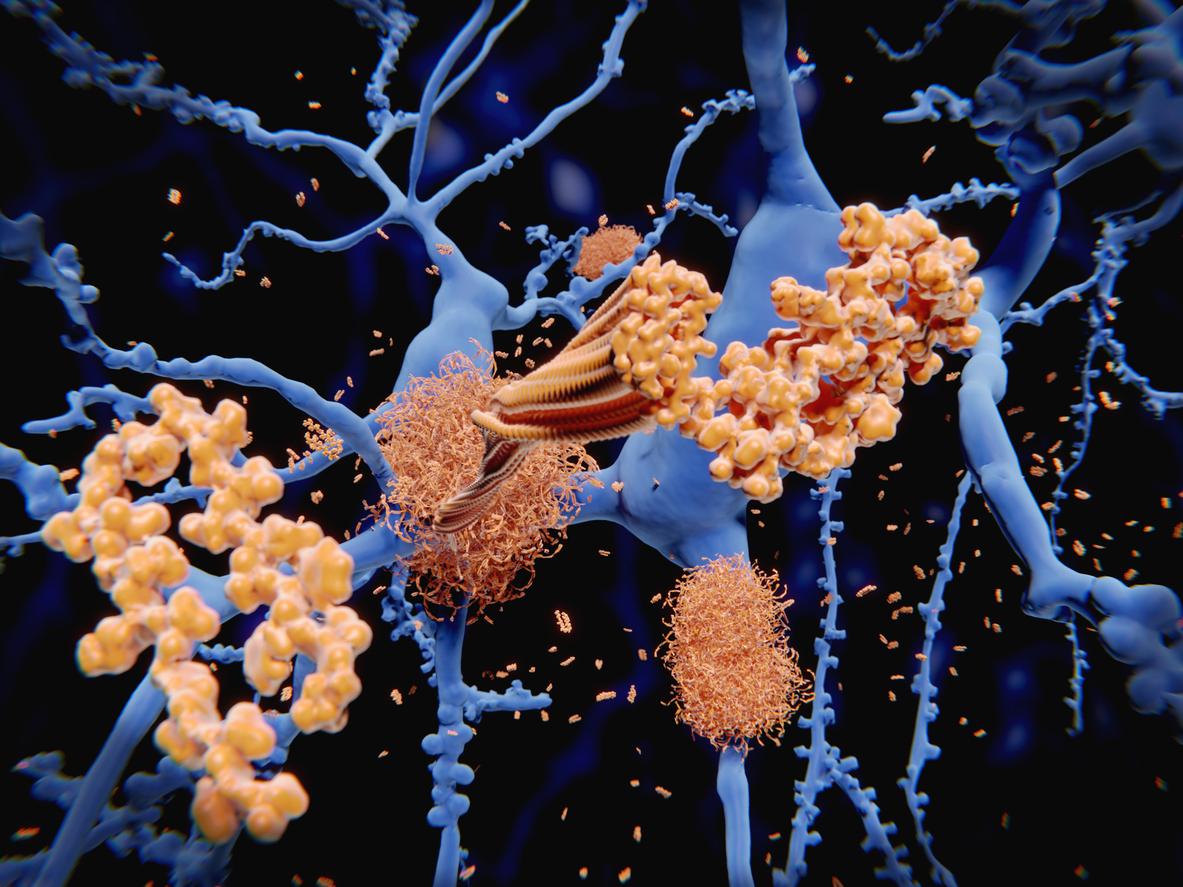 Alzheimer : les plaques bêta-amyloïdes protégeraient le cerveau au lieu de le détruire