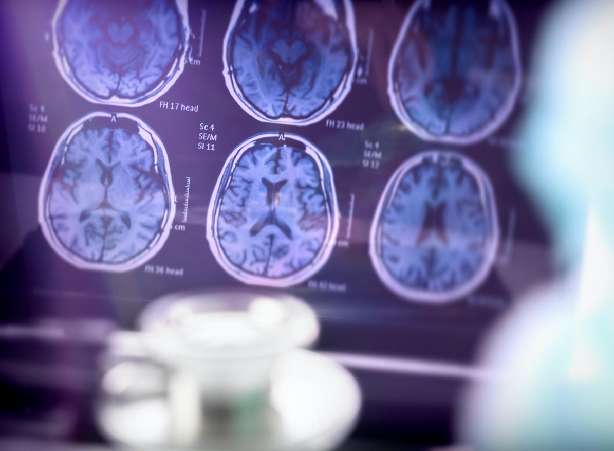 Alzheimer : une nouvelle découverte sur la structure du cerveau ouvre des pistes de traitement