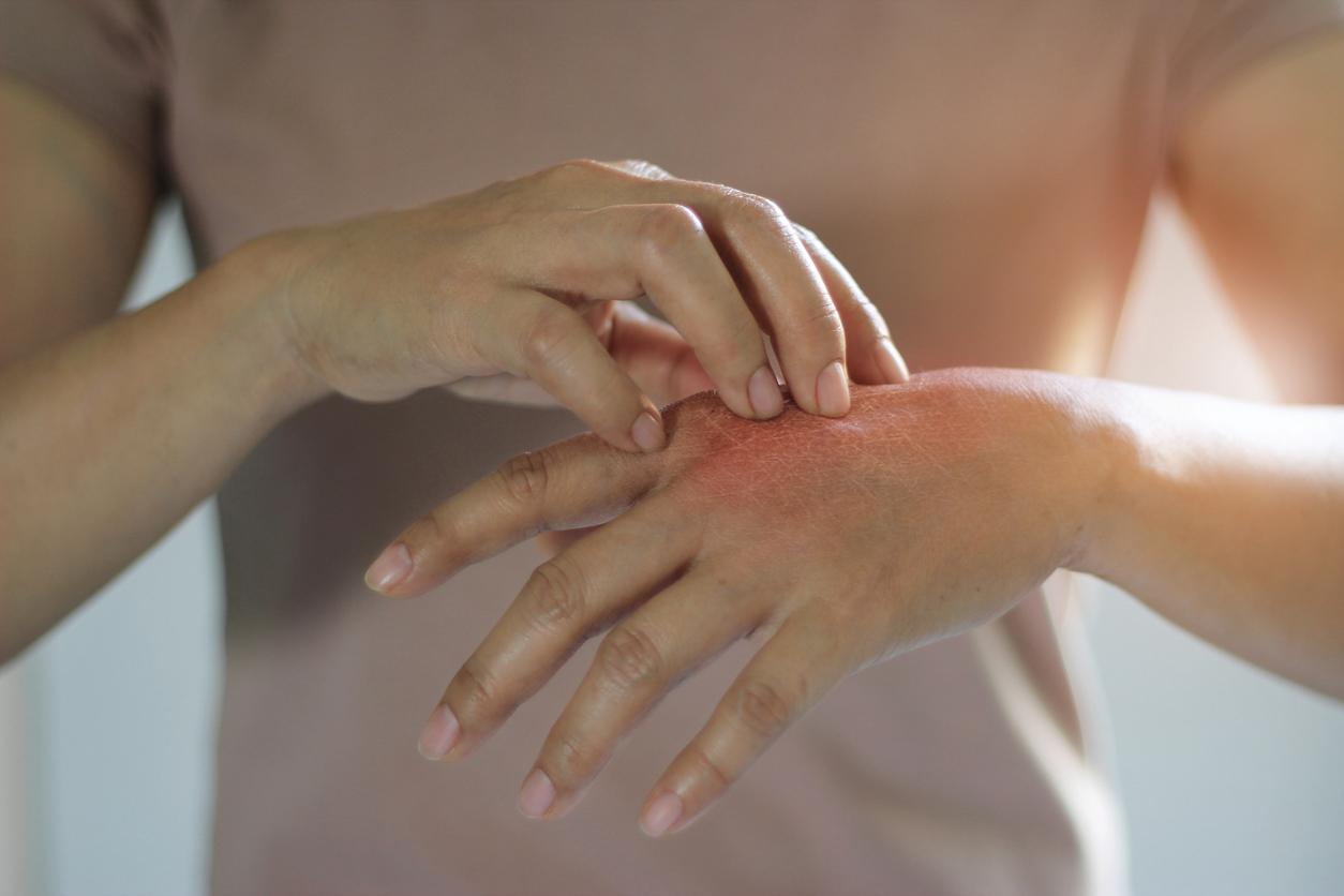 Dermatite allergique de contact : pourquoi certains patients sont plus sensibles que d’autres