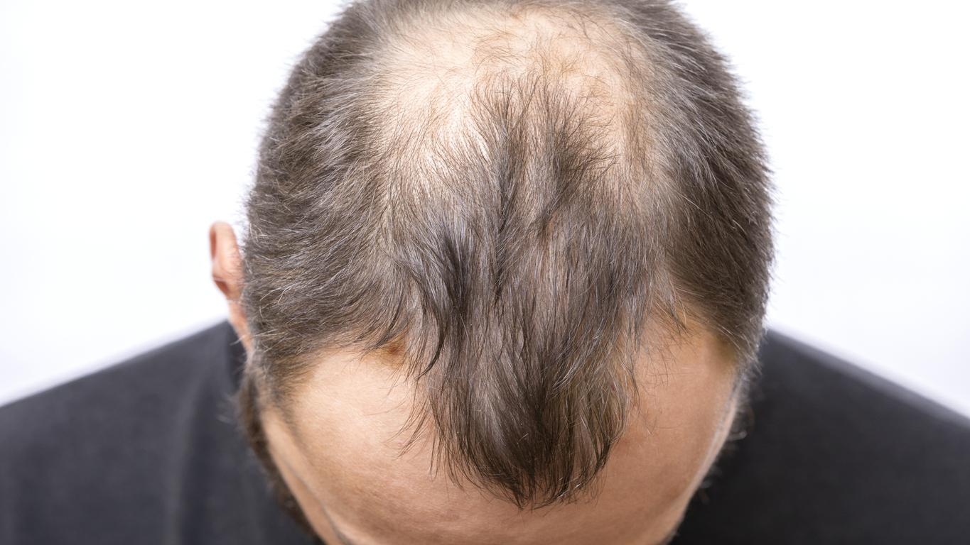 Perte de cheveux et calvitie : quelles sont les causes de l'alopécie ?