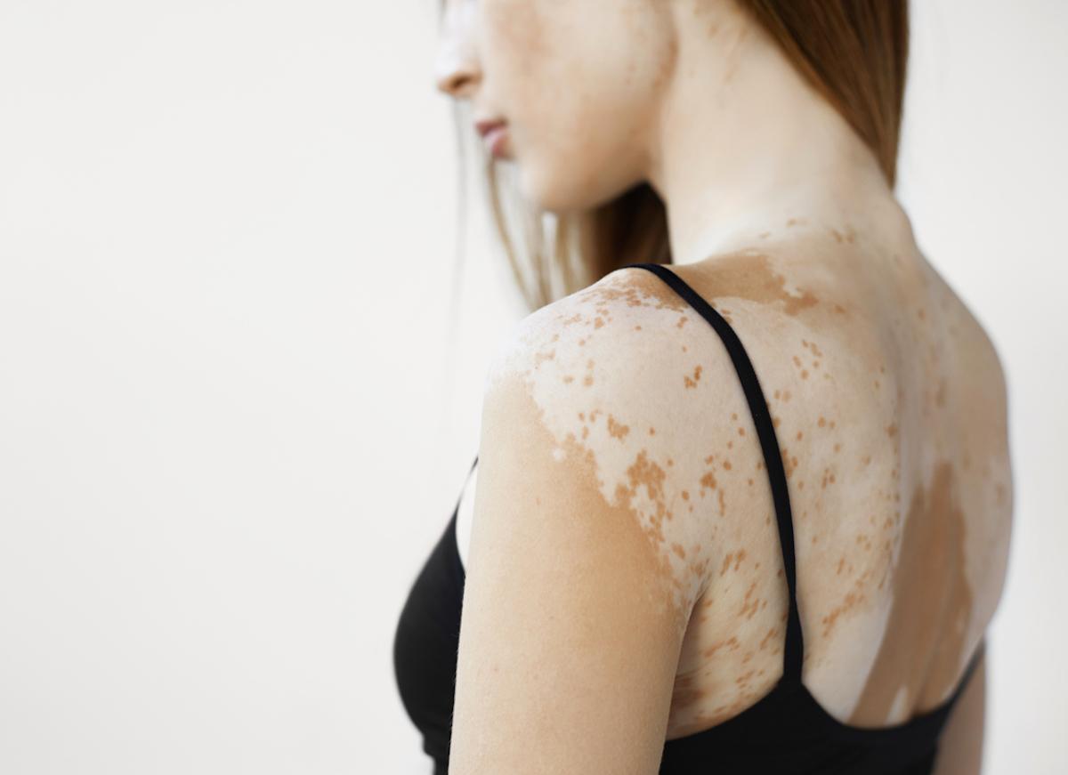 La chanteuse Pomme atteinte du vitiligo : qu'est-ce que cette maladie ?