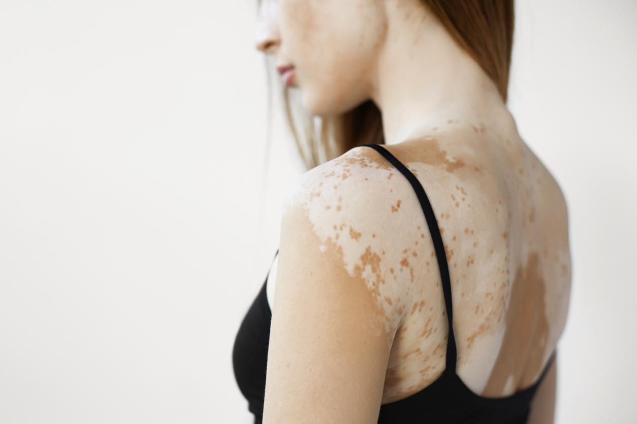 Vitiligo : bientôt un traitement efficace pour repigmenter la peau
