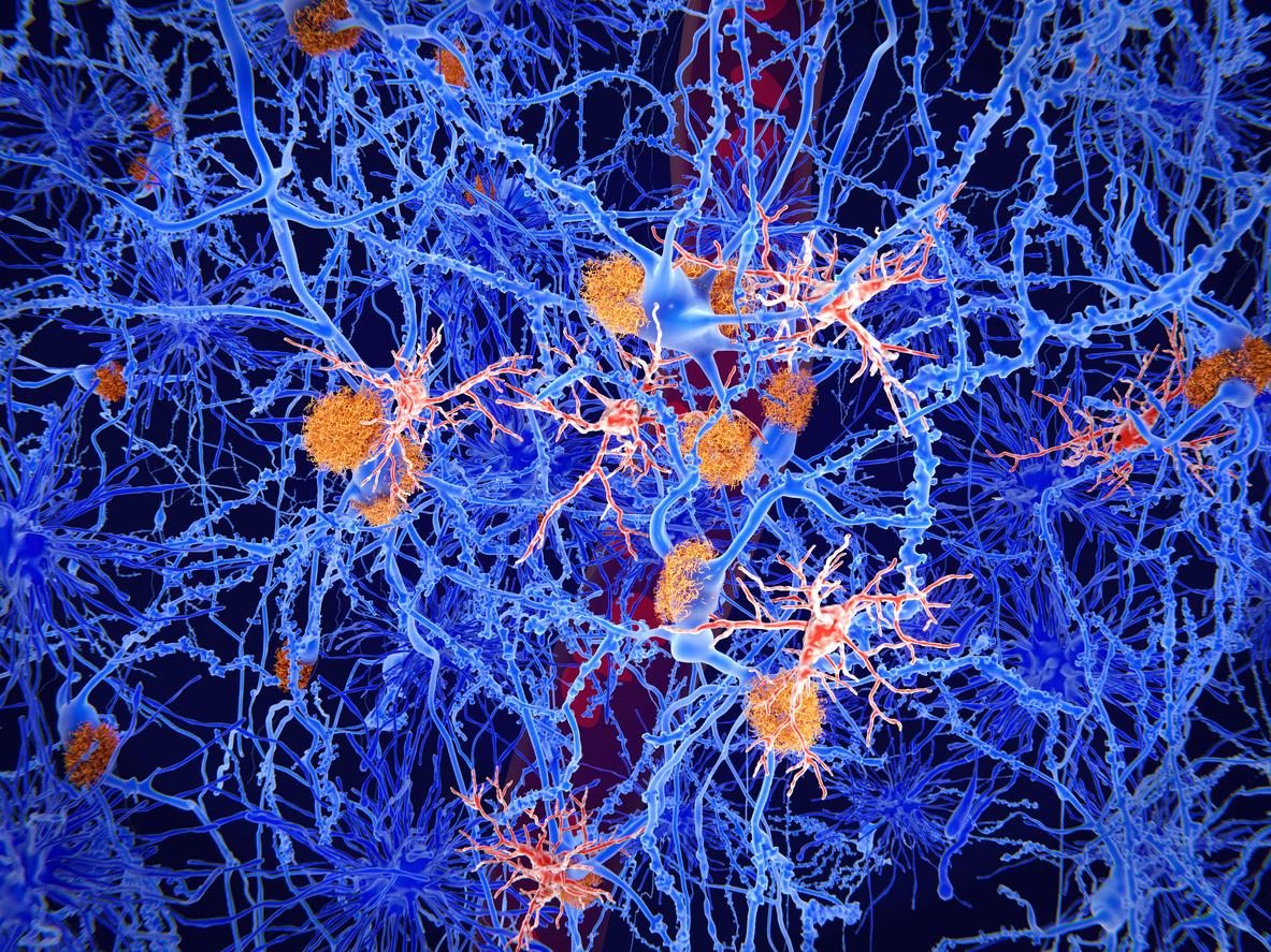 Alzheimer : le processus de création de nouveaux neurones impliqué dans la maladie