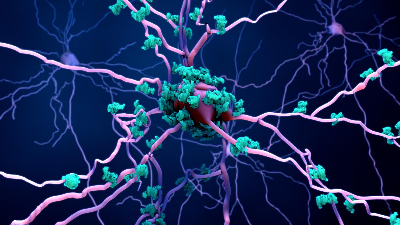 Alzheimer : le cholestérol impliqué dans la production de plaques bêta-amyloïdes