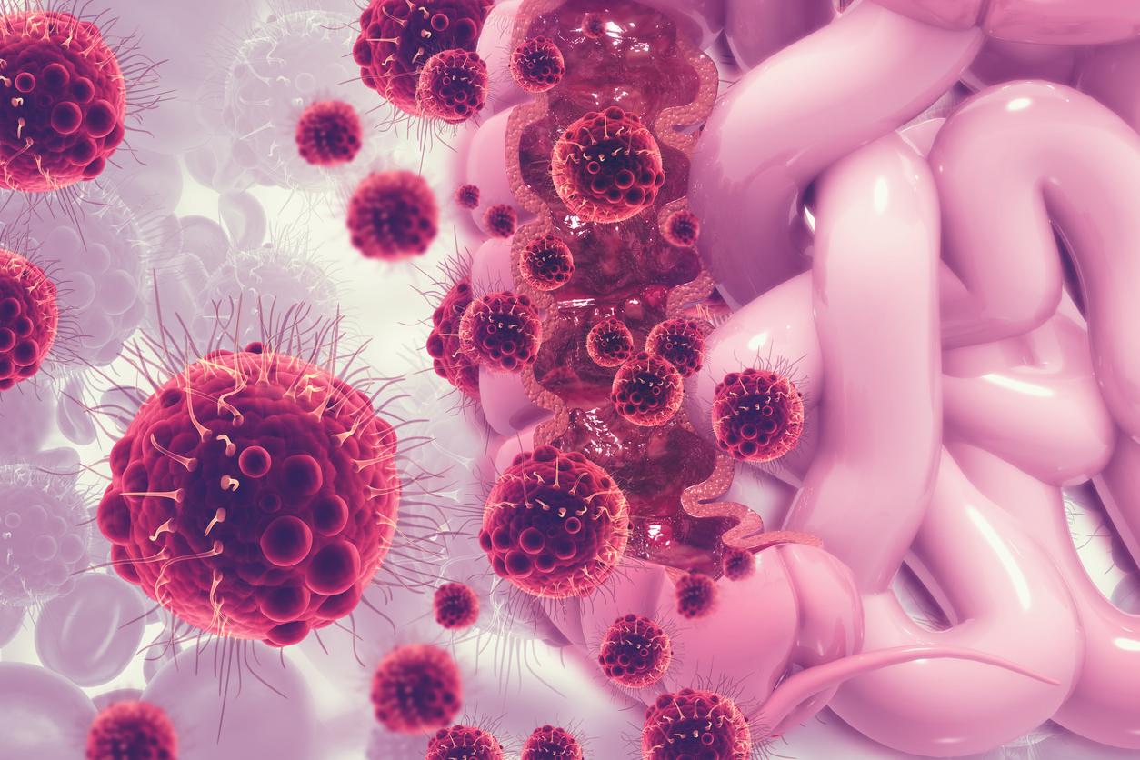 Cancer colorectal : une nouvelle cible thérapeutique pour inhiber la progression des tumeurs