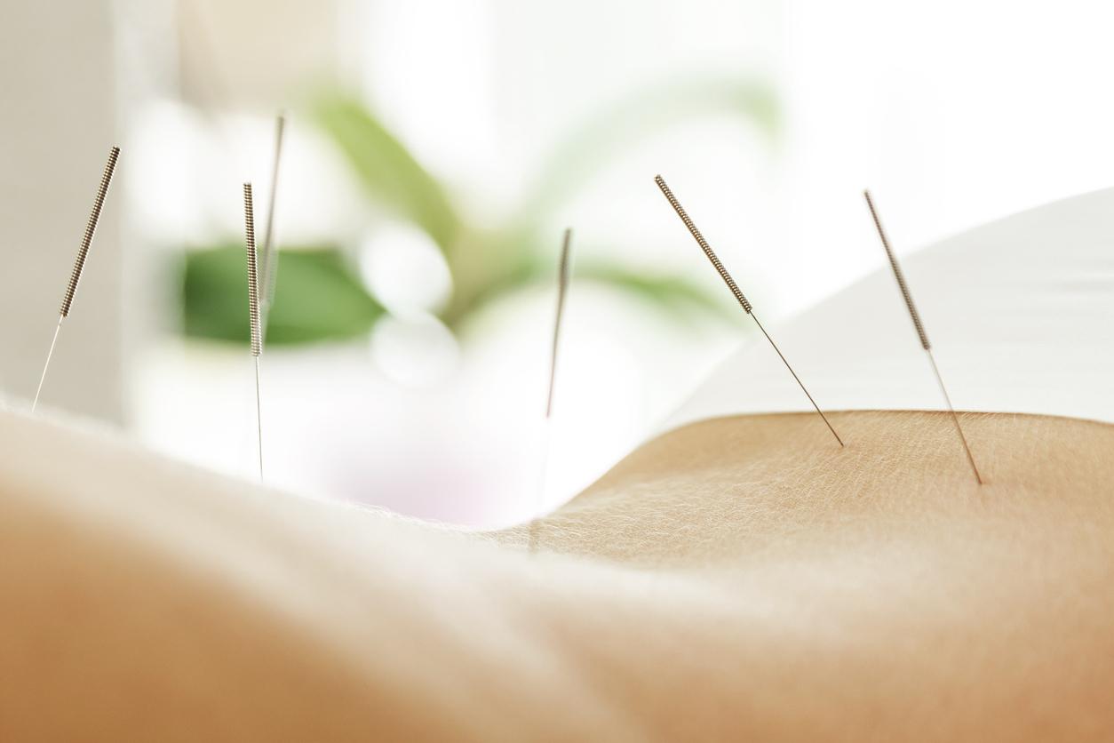 Aphasie motrice post-AVC : l'acupuncture peut réduire les symptômes  