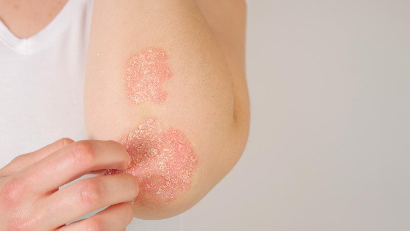 Psoriasis : ce médicament à forte dose réduirait les symptômes 