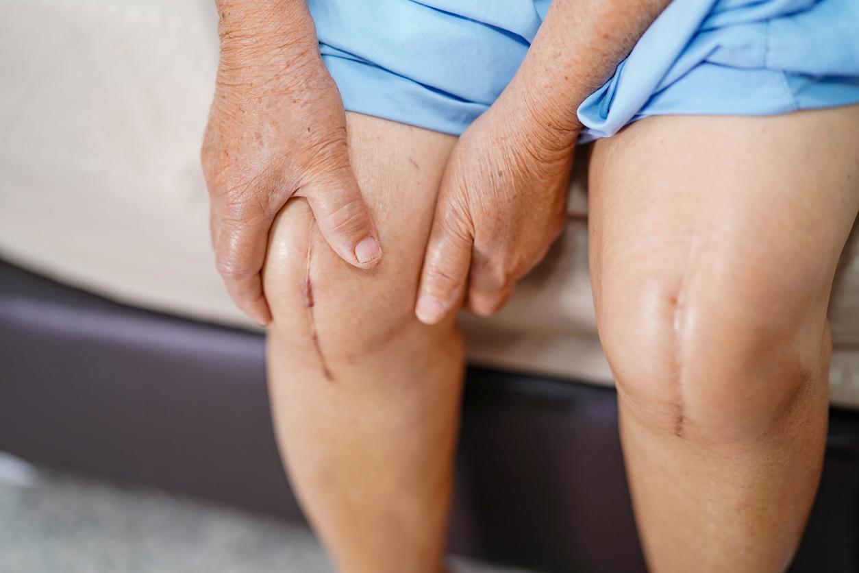 Arthrose du genou : trop de gens se font opérer tardivement 