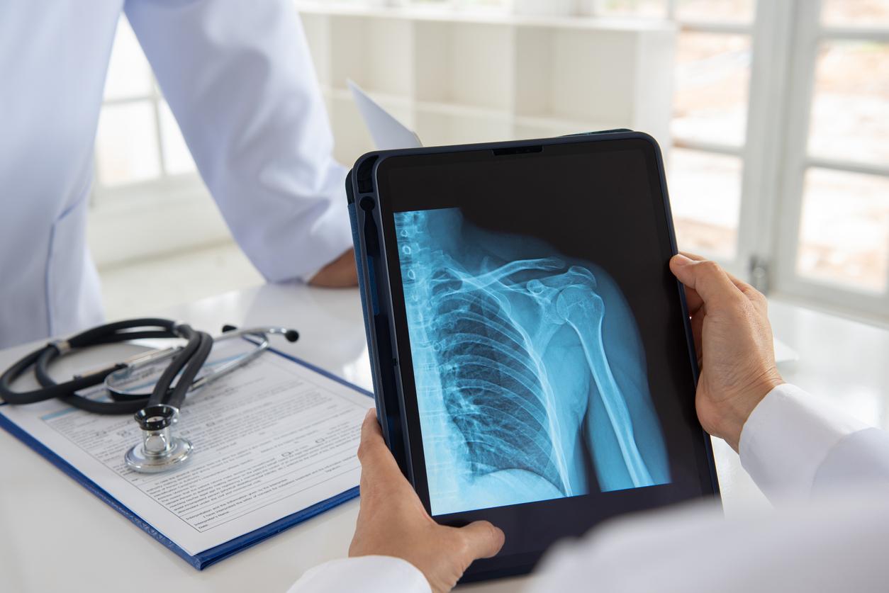 Ostéoporose : et si l’exposition aux PFAS y contribuait ? 