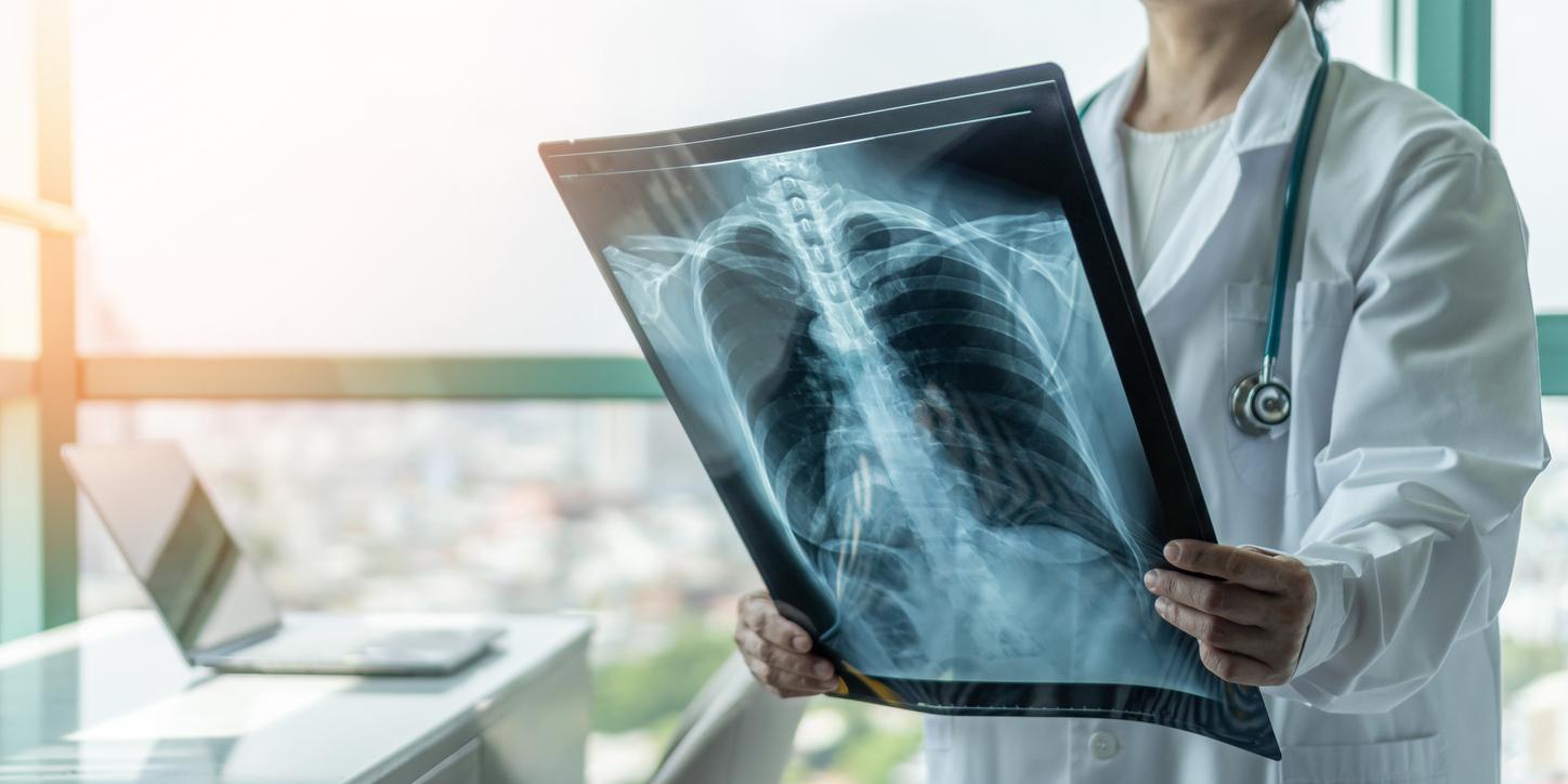 Covid-19 : les complications graves peuvent endommager le tissu pulmonaire